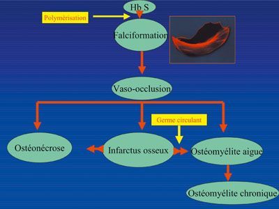 Manifestations ostéo-articulaires de la drépanocytose