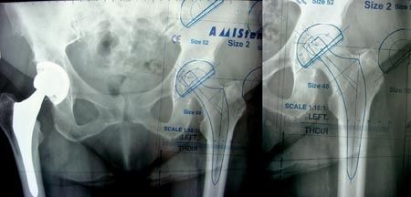 Pourquoi et comment passer à la voie antérieur en décubitus dorsal pour la réalisation d'une prothèse totale de hanche