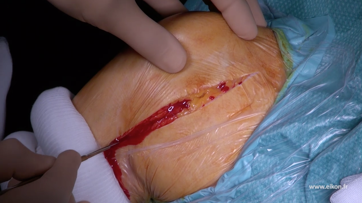 La voie Delto-Pectorale : voie royale des  prothèses d’épaule inversées en 2018 ? Plaidoyer pour le respect du deltoïde