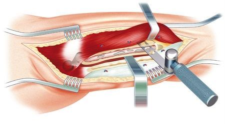Révision des PTH : Voie transfémorale avec volets