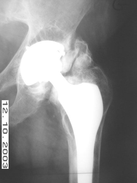 Les ossifications péri prothétiques, la complication (un peu trop ?) oubliée