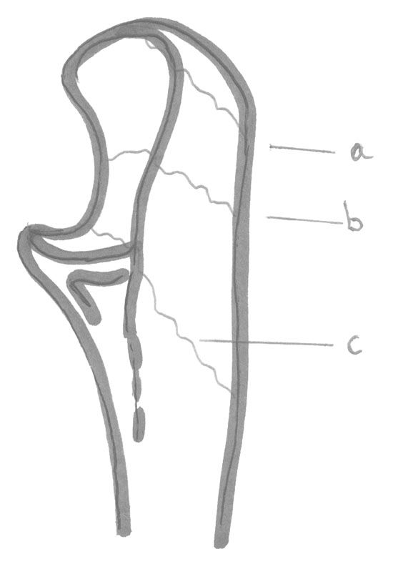 Diagnostic et traitement des fractures fraîches de l'olécrane