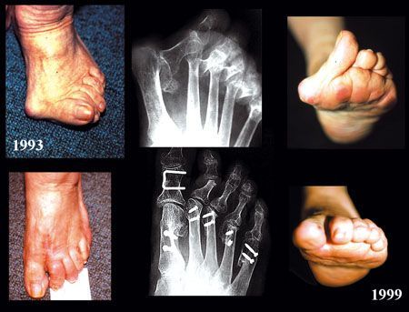 Correction des désordres statiques sévères de l'avant-pied par chirurgie extra-articulaire