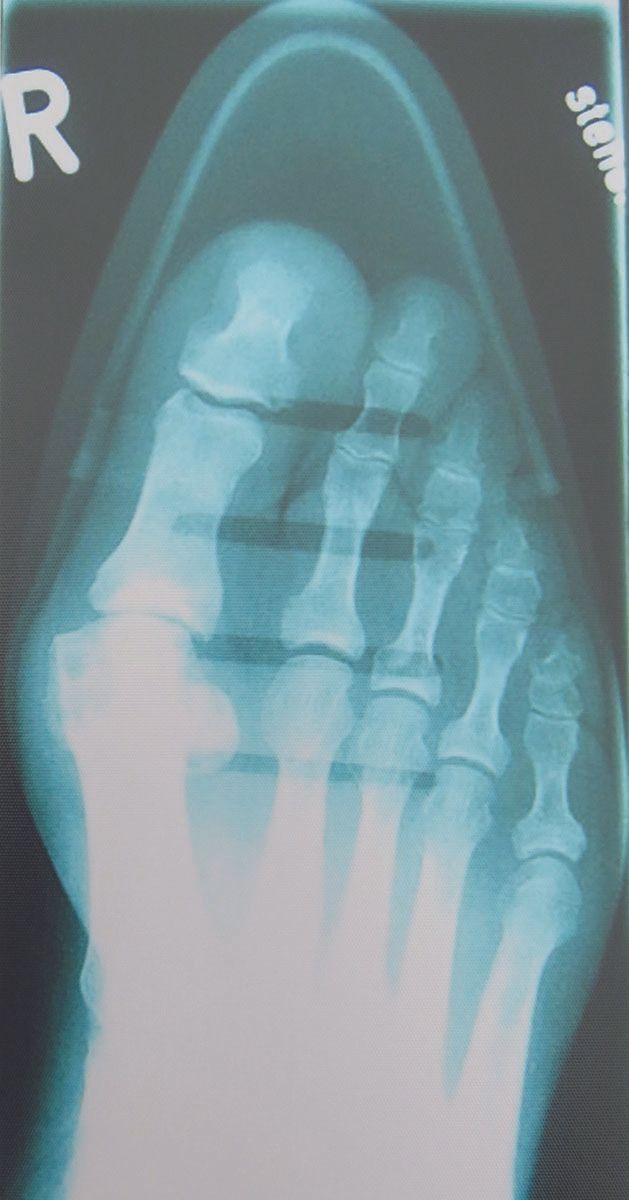 Le syndrome de la chaussure de Cendrillon