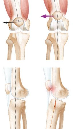 Le rôle du récurvatum dans la pathologie fémoro-patellaire