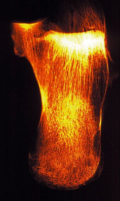 Principes généraux de la réduction et de l'ostéosynthèse des fractures thalamiques du calcaneum