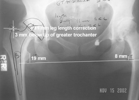 Intérêt dans la PTH d'une voie d'abord postérieur unique et courte avec la tige sans ciment SL-Plus