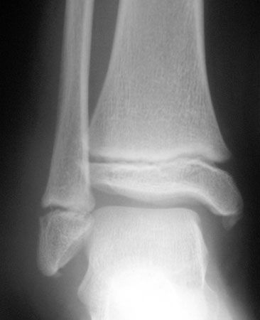 Les fractures de cheville chez l'enfant