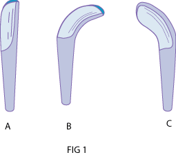 L'embrochage des fractures du membre inférieur chez l'enfant