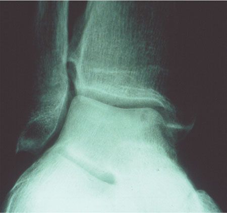 Les lésions ostéochondrales du dôme du talus