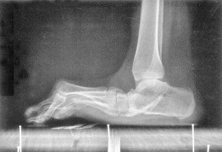 L'hallux flexus avec metatarsus elevatus de l'adulte