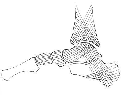 L'ostéosynthèse des fractures thalamiques du calcaneum par plaques "1/4 de tube" montées en triangulation : technique chirurgicale