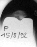 Technique de la patelloplastie en dôme dans les prothèses totales de genou