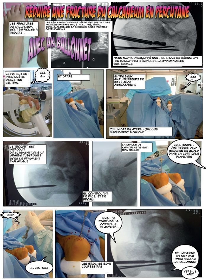 Comment réduire une fracture du calcanéum en percutané avec un ballonnet