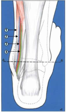 Le syndrome du tunnel tarsien : diagnostic, étiologies et traitement
