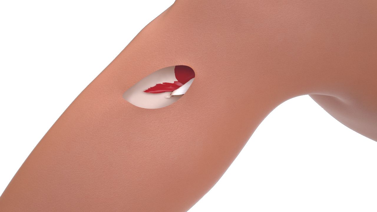 Ligamentoplastie externe de cheville anatomique et mini-invasive utilisant le gracilis : Technique  A.L.L. (Ankle Lateral Ligamentoplasty)