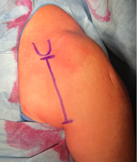 Voie d’abord préservant le deltoïde et  le sous-scapulaire pour la mise en place  de prothèses inversées  Technique chirurgicale et résultats préliminaires