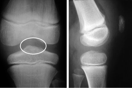 La rupture du ligament croisé antérieur de l'enfant