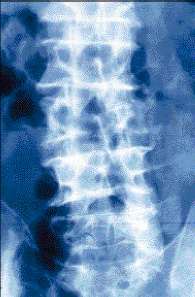 Métastases vertébrales : Stratégie diagnostique et thérapeutique