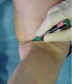 Abord mini-invasif de la surface rétrospinale