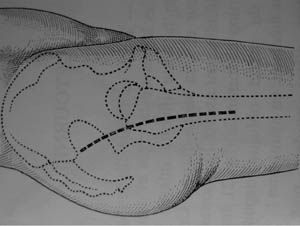 Le "Minipost", mini abord postéro-externe pour prothèse de hanche