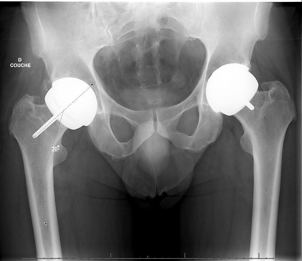 Gestion prothétique des hanches en coxa vara et à déport fémoral augmenté : intérêt du resurfaçage de hanche