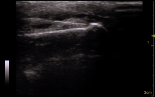 La chirurgie osseuse de la main sous anesthésie Walant