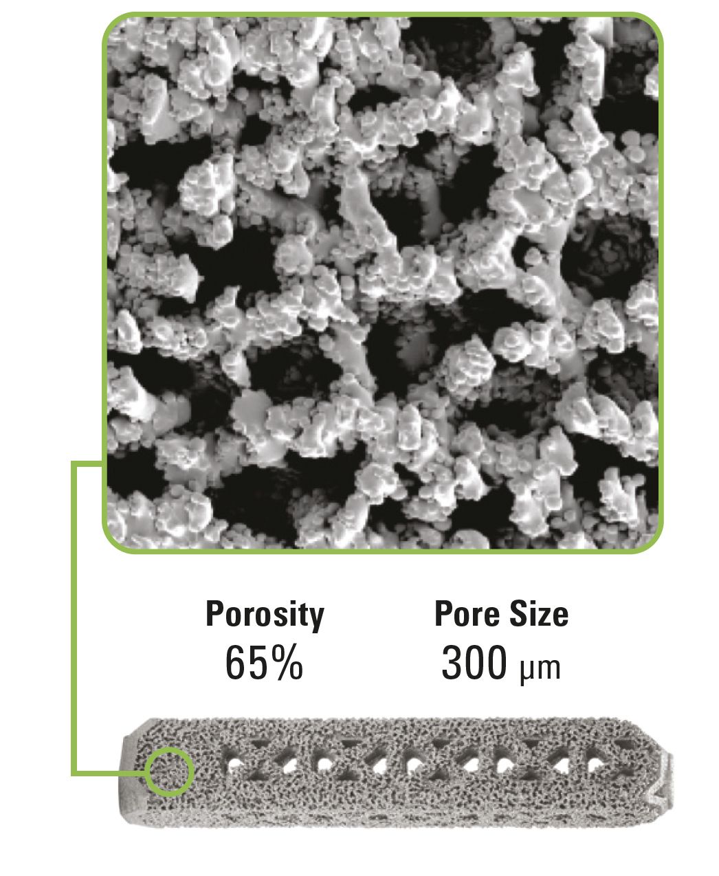 Pathologie de l’articulation Sacro-iliaque : étude clinique et résultats préliminaires de l’arthrodèse