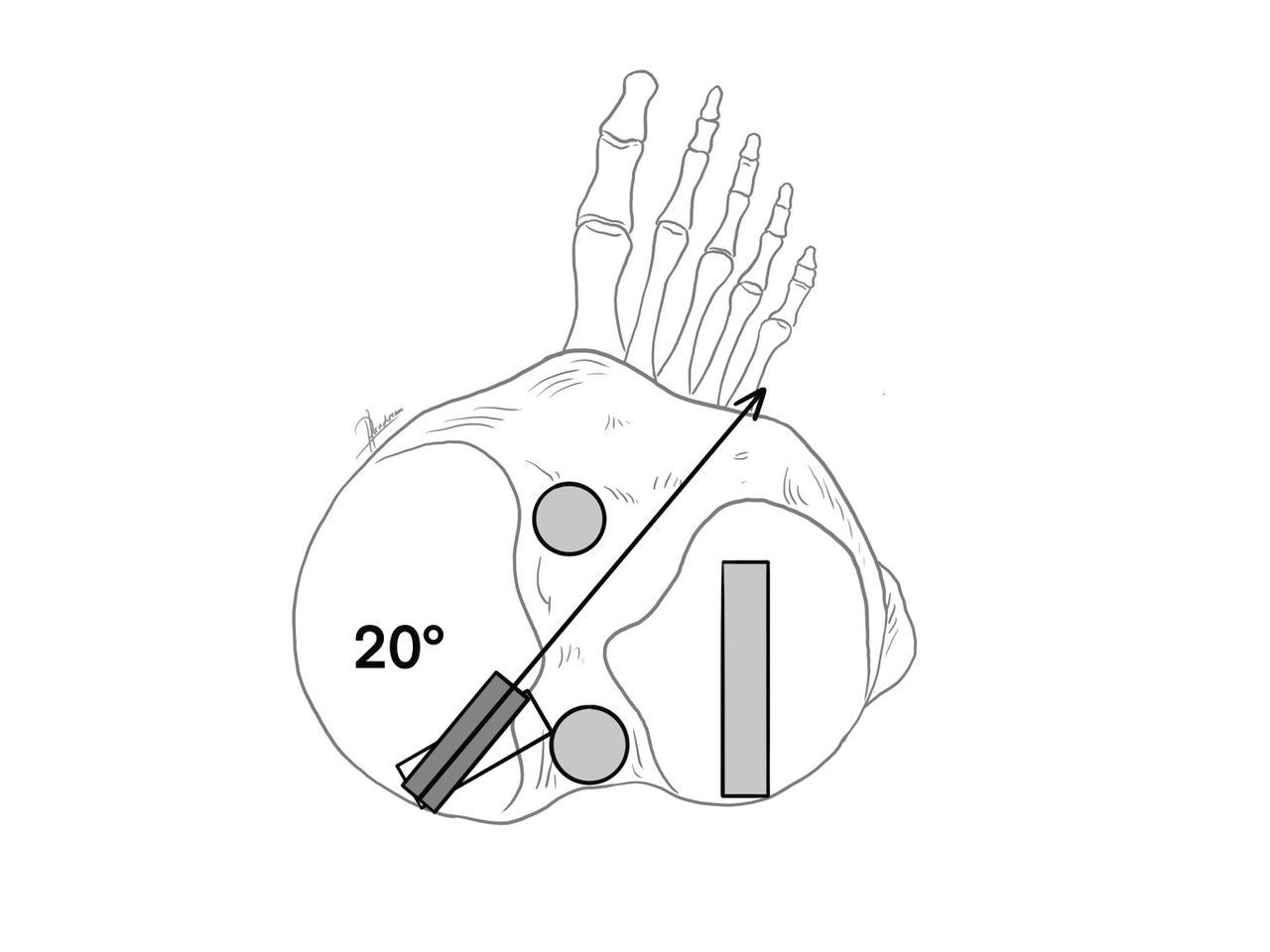 Comment éviter la convergence des tunnels au cours de la chirurgie multi-ligamentaire du genou :  guide pratique