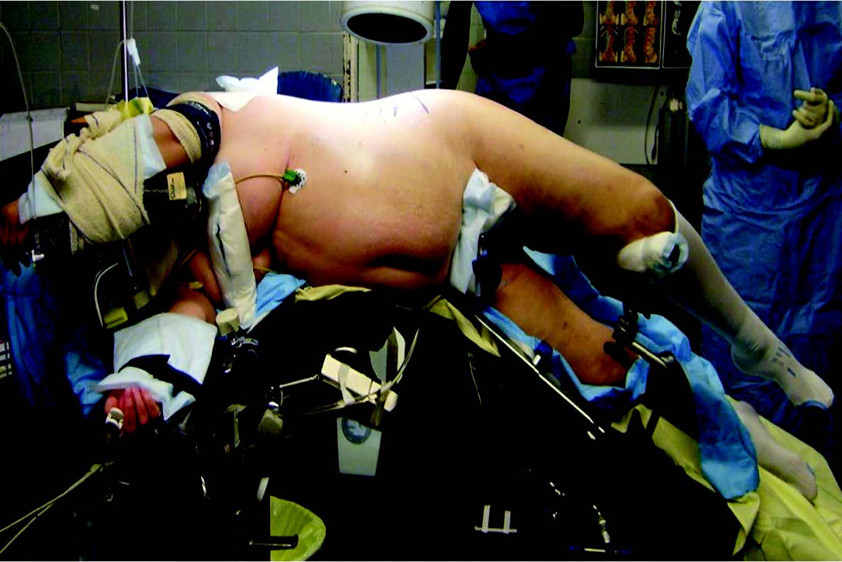 Technique de l’arthrodèse intersomatique par voie latérale mini-invasive pré-psoatique