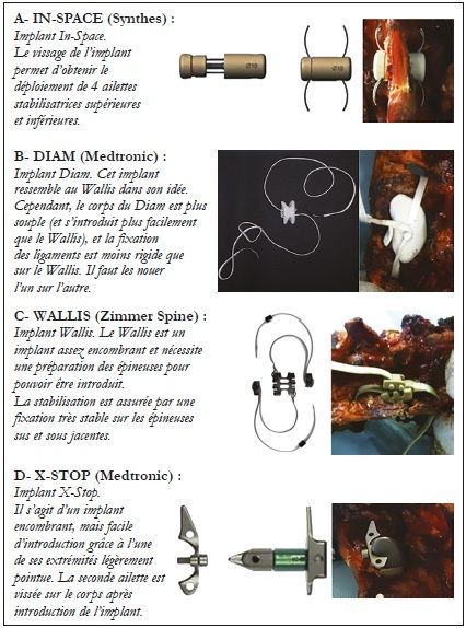Effets biomécaniques des dispositifs inter épineux lombaires