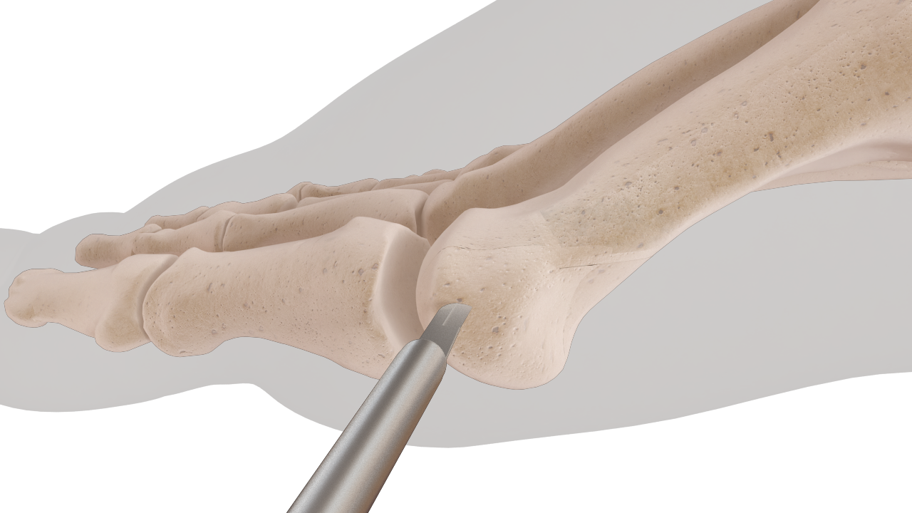 Le chevron percutané FAST