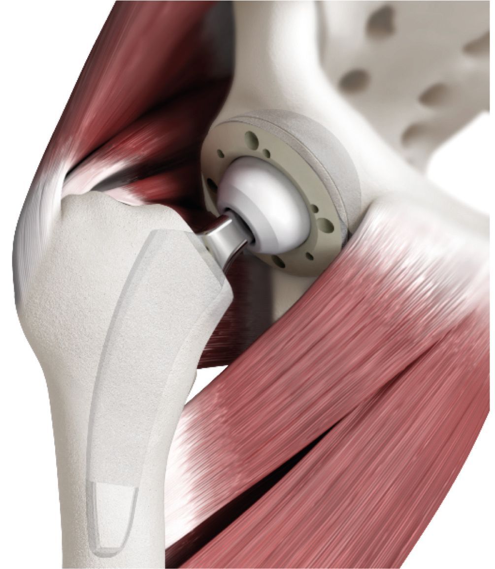 Tiges courtes guidées par l’éperon de Merkel : un tournant dans la prothèse totale  de hanche moderne