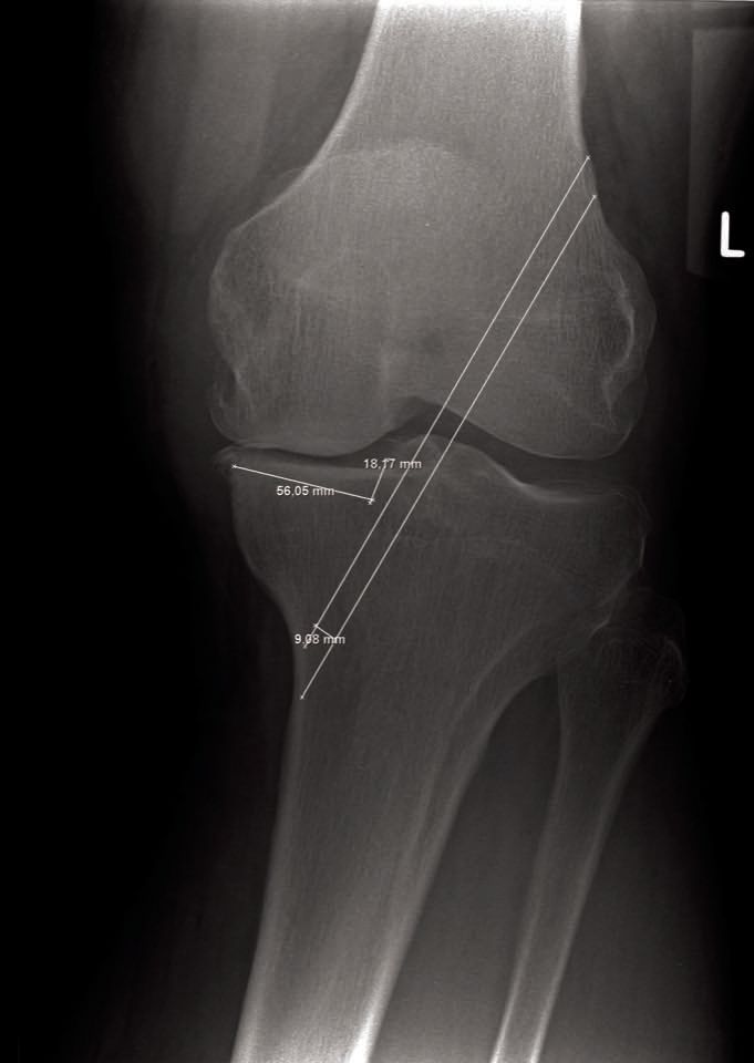 Reconstruction du ligament croisé antérieur et arthroplastie unicompartimentale du genou