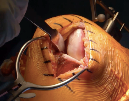 Techniques chirurgicales  des PUC internes vs PUC externes