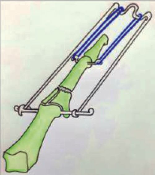 Le "cadre de Kolkata" -  un distracteur dynamique polyvalent  pour luxation par fracture dorsale de l'articulation interphalangienne proximale