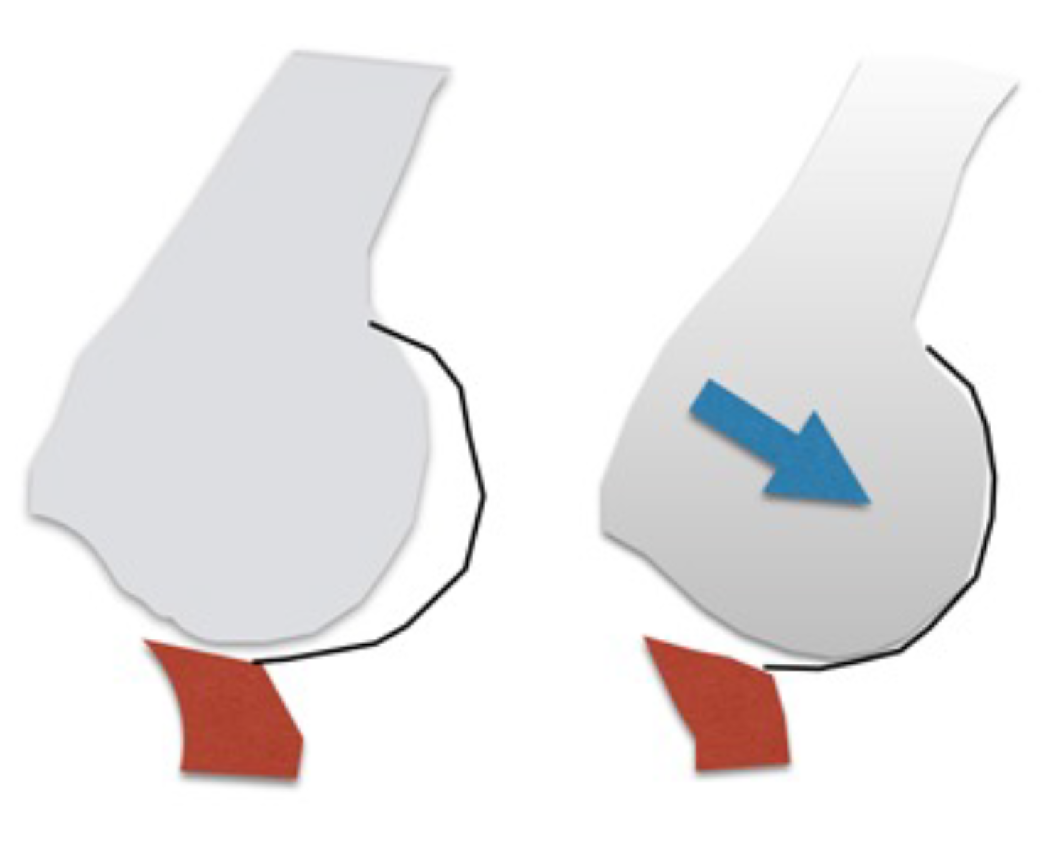Traitement de l'instabilité de l'épaule associée à des lésions bipolaires