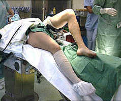 Traitement chirurgical des lésions récentes et anciennes du LCA par l'opération de Mac Intosh au fascia lata modifiée par Jaeger J