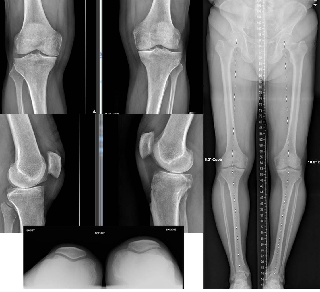 Prothèses unicompartimentaires bilatérales en un temps : Technique opératoire et revue systématique de la littérature