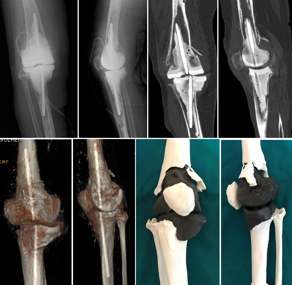 L’utilisation de modèles tridimensionnels imprimés en 3D pour la chirurgie prothétique de révision du genou