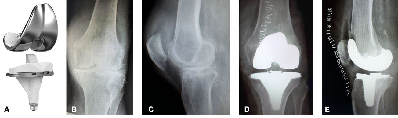 Prothèse totale de genou  postéro-stabilisée KNEO technique opératoire