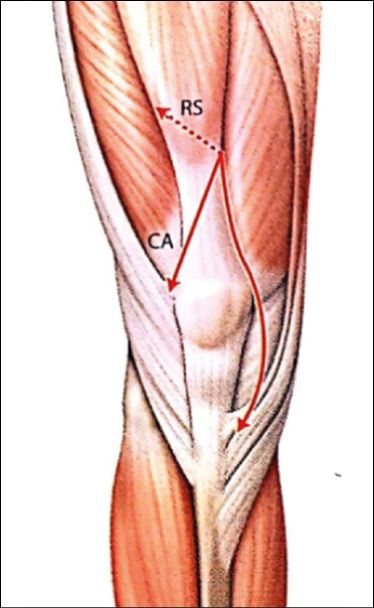 Ostéotomie de la tubérosité tibiale antérieure et fixation par ostéosuture