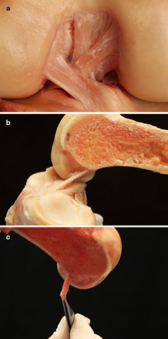 Histoire naturelle d’une lésion du ligament croisé antérieur : les lésions associées et les conséquences de l’instabilité rotatoire