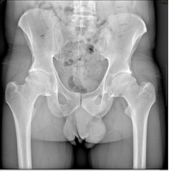 Tiges courtes guidées par le calcar dans l’arthroplastie totale de hanche : Pourquoi ? Pour qui ? Comment ?