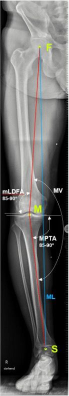 Traitement de la gonarthrose médiale au moyen d'une ostéotomie de valgisation tibiale par addition interne biplanaire : 20 ans d'expériences, trucs et astuces