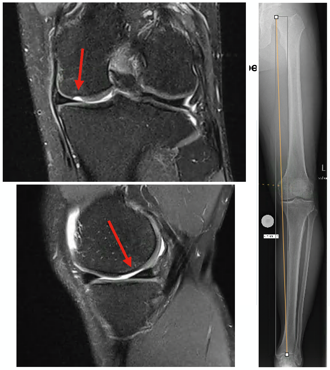 Approches thérapeutiques de régénération du cartilage combinées à une ostéotomie de réalignement de l'articulation du genou