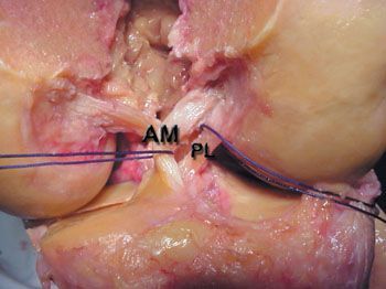 La reconstruction du ligament croisé antérieur par greffe à deux faisceaux utilisant les tendons de la patte d'oie