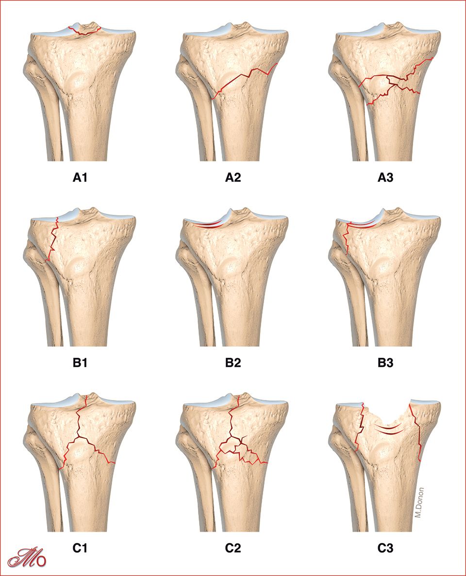 Prise en charge des fractures du plateau tibial : diagnostic, classification et traitement