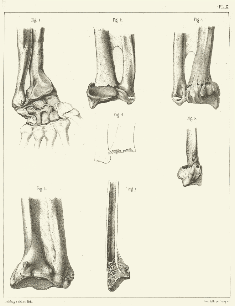 Extrait de l'Atlas du traité des fractures et des luxations. Planche X : fractures de l'extrémité inférieure du radius