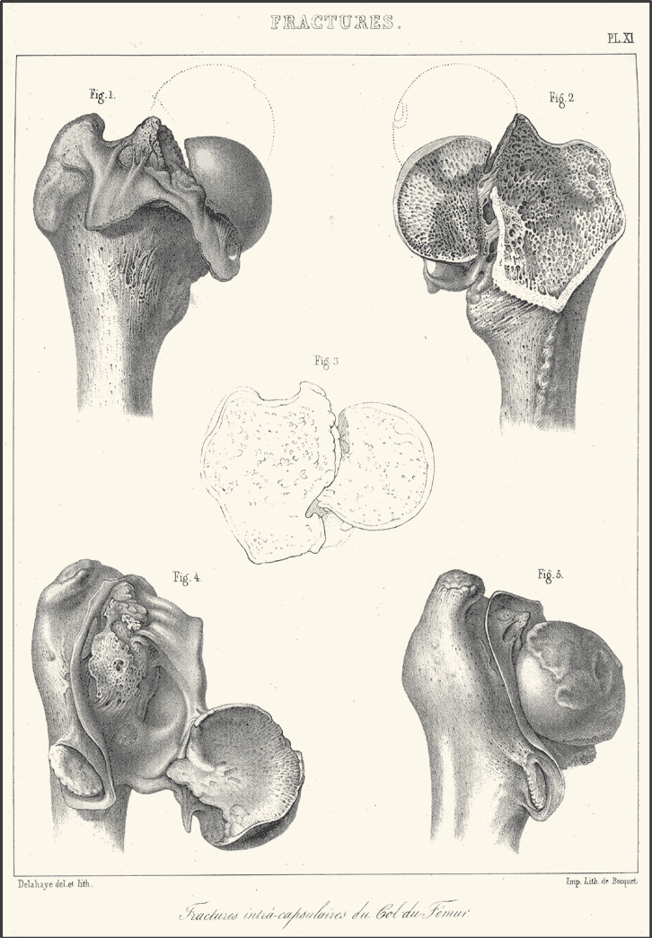 Extrait de l'Atlas du traité des fractures et des luxations. Planche XI : FRACTURES CAPSULAIRES